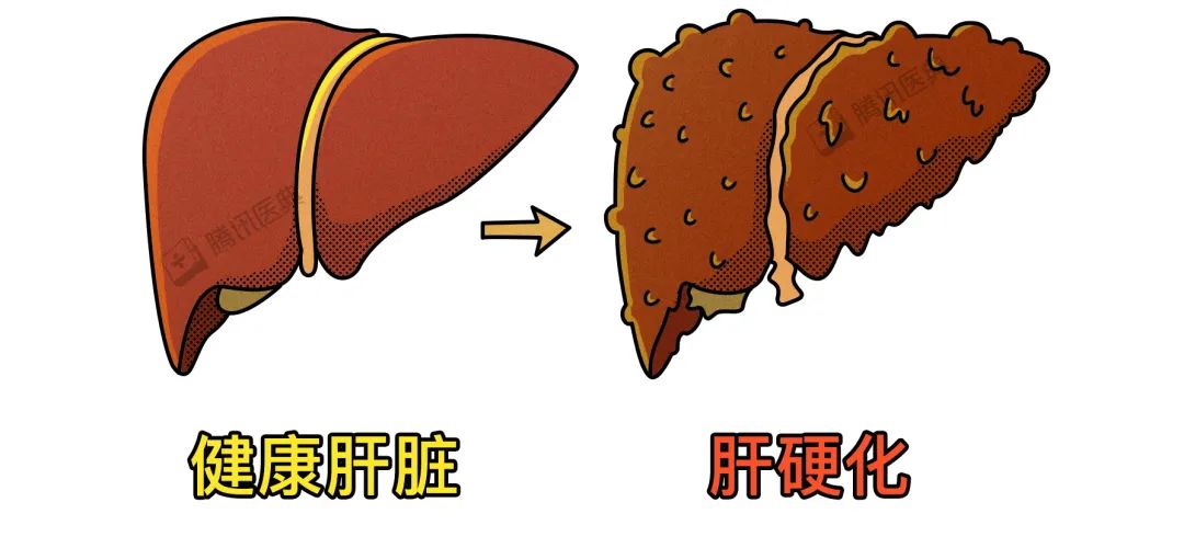 王福生院士：臍帶間充質(zhì)幹細胞顯著改善失代償性肝硬化的肝功能(néng)，提高長(cháng)期生存率(圖2)