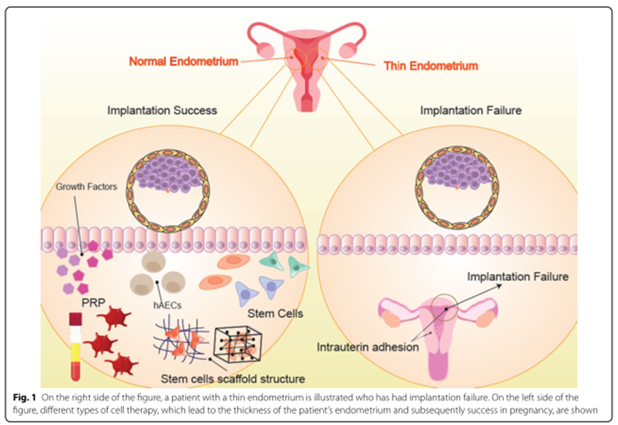 期刊新(xīn)綜述高級别證據：幹細胞、PRP等療法再生子宮内膜，多(duō)個家庭成功受孕(圖2)